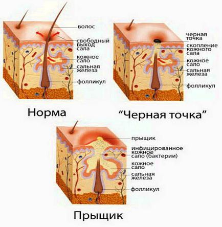 Видалення чорних крапок інструменти, способи - вибираємо кращі