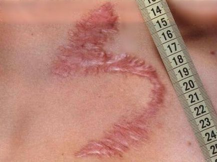 Видалення рубців і шрамів на обличчі і тілі види шрамів і способи їх видалення