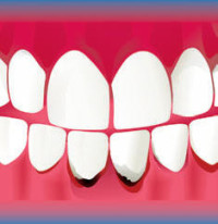 Видалення зубного каменю ультразвуком або лазером - ціни, відгуки