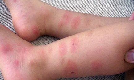 Ухапвания от насекоми при деца снимки, знаци, лечение