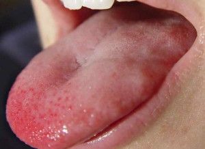 У дитини білий наліт на язиці причини і лікування