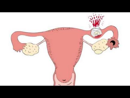 Dacă uterul crește cu o sarcină ectopică dacă stomacul, tipurile, diferențele și simptomele