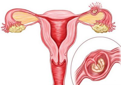 Чи збільшується матка при позаматкової вагітності зростає чи живіт, види, відмінності та симптоми