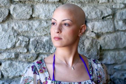 Випадання волосся після хіміотерапії можна зупинити
