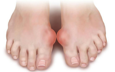 Inflamația oaselor pe picior cauzează, cum se tratează, îndepărtarea inflamației