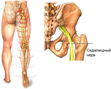 Inflamația simptomelor nervului sciatic și tratamentul apăsării nervului sciatic - clinica martie