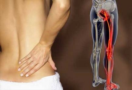 Inflamația simptomelor nervului sciatic și tratamentul apăsării nervului sciatic - clinica martie