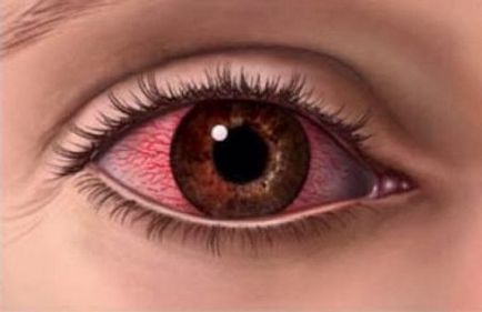 Запалення склери ока симптоми і лікування