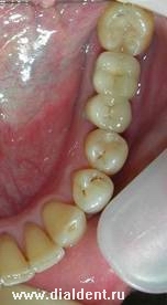 Restaurarea integrității dentiției cu ajutorul implantării dinților - implantologie - știri și