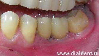 Відновлення цілісності зубного ряду за допомогою імплантації зубів - імплантологія - новини і
