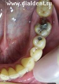 Restaurarea integrității dentiției cu ajutorul implantării dinților - implantologie - știri și