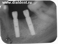 Відновлення цілісності зубного ряду за допомогою імплантації зубів - імплантологія - новини і