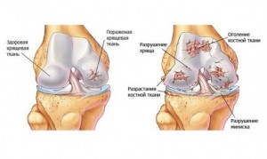 Відновлення хрящової тканини колінного суглоба