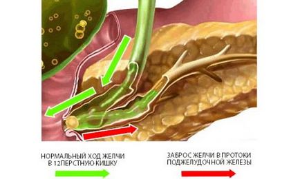 Cholecystopancreatitis imaginea clinică a bolii și șansele de a salva viața