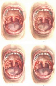 Хронічний тонзиліт лікування, симптоми, причини