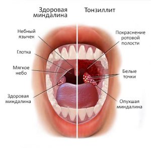 Хронічний тонзиліт лікування, симптоми, причини