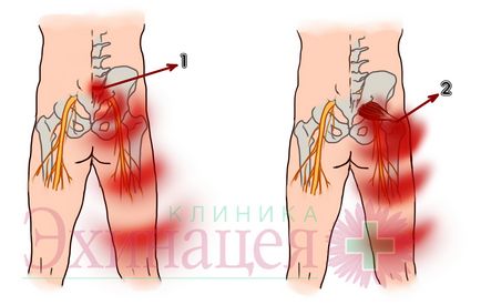 Strângerea (ciupirea) nervului sciatic (sciatica)