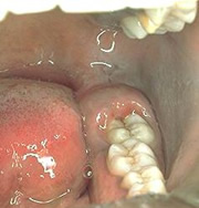 Dificultate de erupție a dintelui de înțelepciune inferior - stomatologie