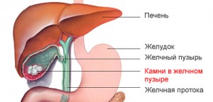 Boli biliari - diagnostic și tratament al colelithiozelor, clinica din Israel, tratament în