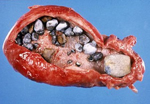 Semne de boală de biliară, simptome, diagnosticare și prevenire a zhkb