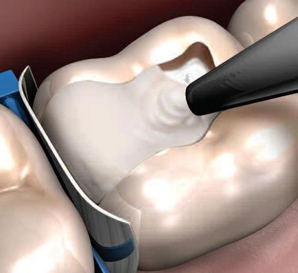 Umplerea dinților - prețul umplerii dinților, sigiliile din stomatologie