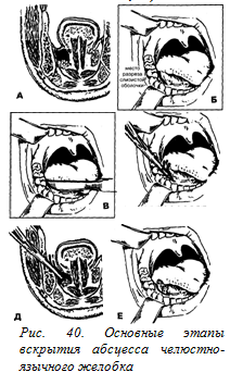 Abcesul canelurii maxilo-faciale - un portal dentar bun, o dentară bună