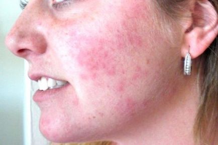 Allergia az arcon - kiütés és piros foltok és hogyan kell kezelni