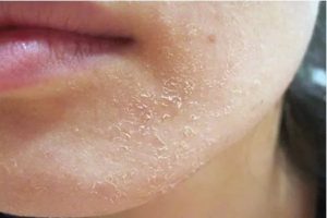Алергия на лицето - обрив и червени петна, които правят и как да се отнасяме