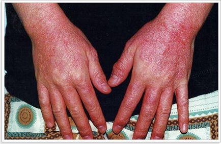 Алергія на воду у дітей і дорослих ознаки лікування