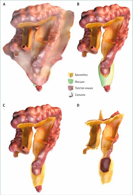 Analiza histologiei cu BC, ocq (boala Crohn)