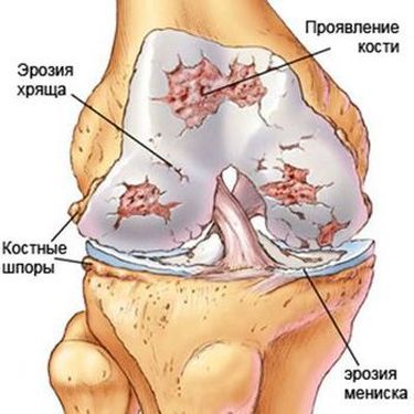 Anatomy of a térdízület fő betegség és a kezelés