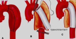 Anevrismul vascular provoacă, simptome, diagnostic și tratament