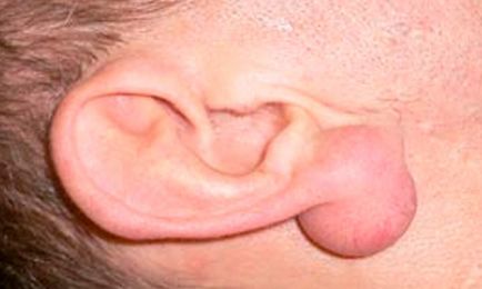 Атерома мочки вуха