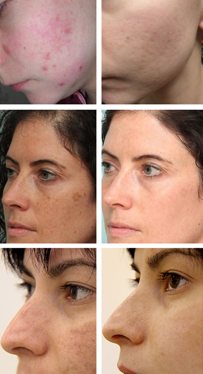 Badya de la acnee și pete pe fața recenzii, instrucțiuni, fotografii înainte și după
