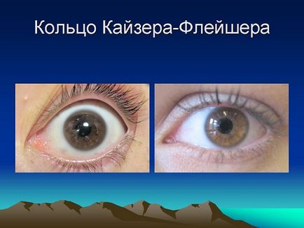 Хвороба Вільсона-Коновалова причини, патогенез, клініка