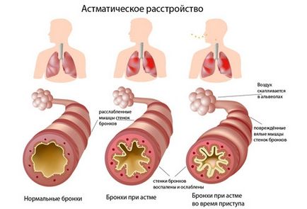 Чого не можна робити при бронхіальній астмі, довго жити