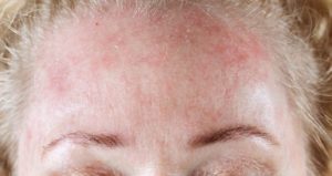 Dermatita pe fața cauzelor adulților și a tratamentului