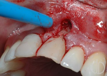 Gingiile se îndepărtează de dinți ca un tratament, cum să tratezi totul!