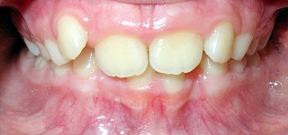 Ortodont de copii în Samara, corectarea mușcăturii la copii, înscrierea în ortodontul copilului,