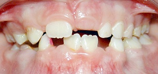 Ortodont de copii în Samara, corectarea mușcăturii la copii, înscrierea în ortodontul copilului,