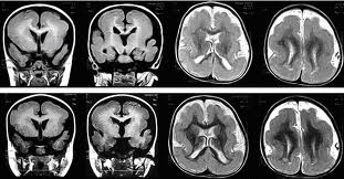 Paralizia cerebrală (DSP) cauzează, simptome, speranța de viață și tratamentul bolii
