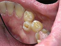 Діагностика гіпердонтіі - а-пломб - стоматологічна клініка