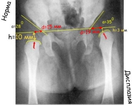 Дисплазія тазостегнових суглобів у дітей і способи її лікування