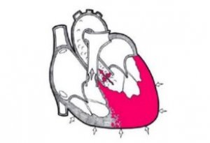 ECG (electrocardiografie)