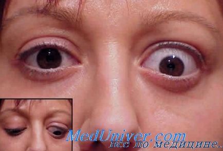 Endokrin myopathia (myopathia) endokrin myopathia