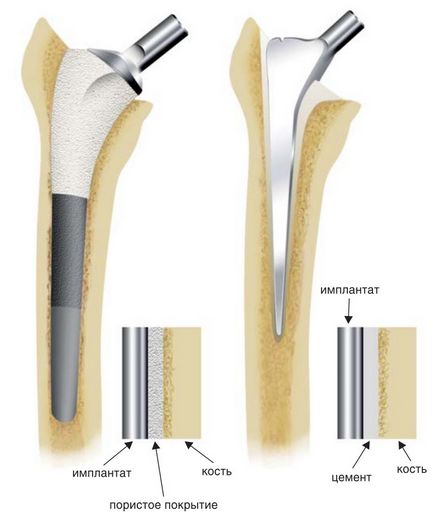 Csere arthroplasty javallatok, ellenjavallatok, szövődmények