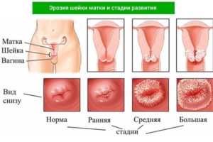 Eroziunea cauzelor de col uterin și factorii de risc pentru boală