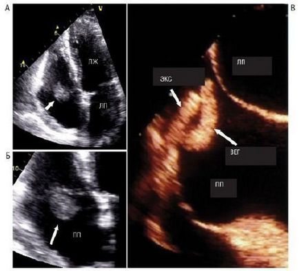 Semnele ecocardiografice ale endocarditei infecțioase