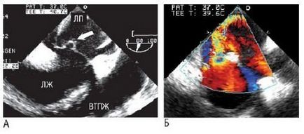 Echokardiográfiás jelei fertőzéses szívbelhártya-gyulladás