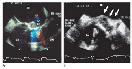 Echokardiográfiás jelei fertőzéses szívbelhártya-gyulladás